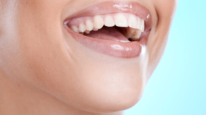 woman smiling with her new veneers